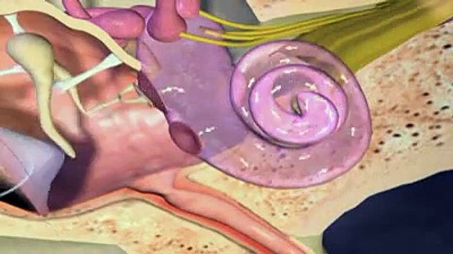 Audition : les implants cochléaires expliqués en vidéo