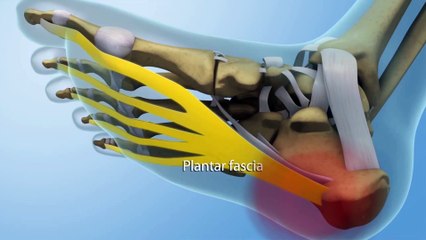 2 Major Causes of Heel Pain: Plantar Fasciitis and Achilles Tendinitis