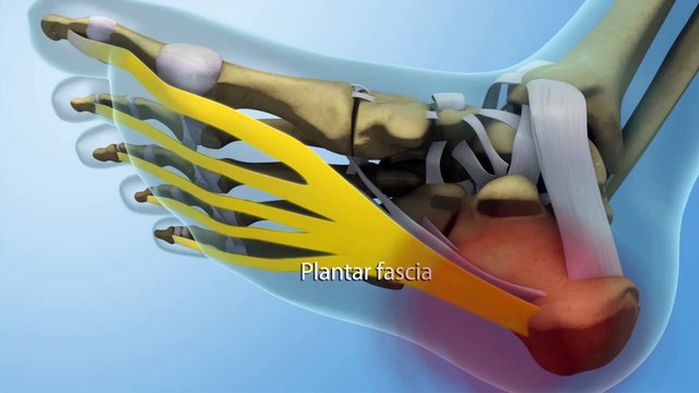 Heel Pain: Is it a Heel Spur or Plantar Fasciitis?