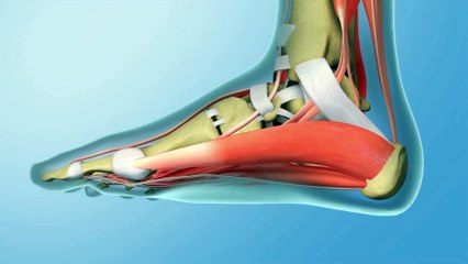Morning Heel Pain is Caused by Plantar Fasciitis
