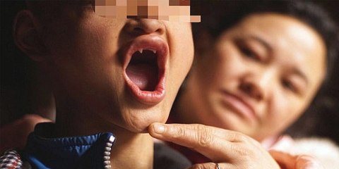 Un garçon chinois de 15 ans souffre d'une maladie étrange qui lui a amené un regard "vampire".