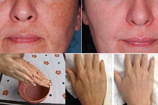 Como ter a PELE ROSADA e sem MANCHAS, como ter uma pele lisinha e sem rugas receita caseira