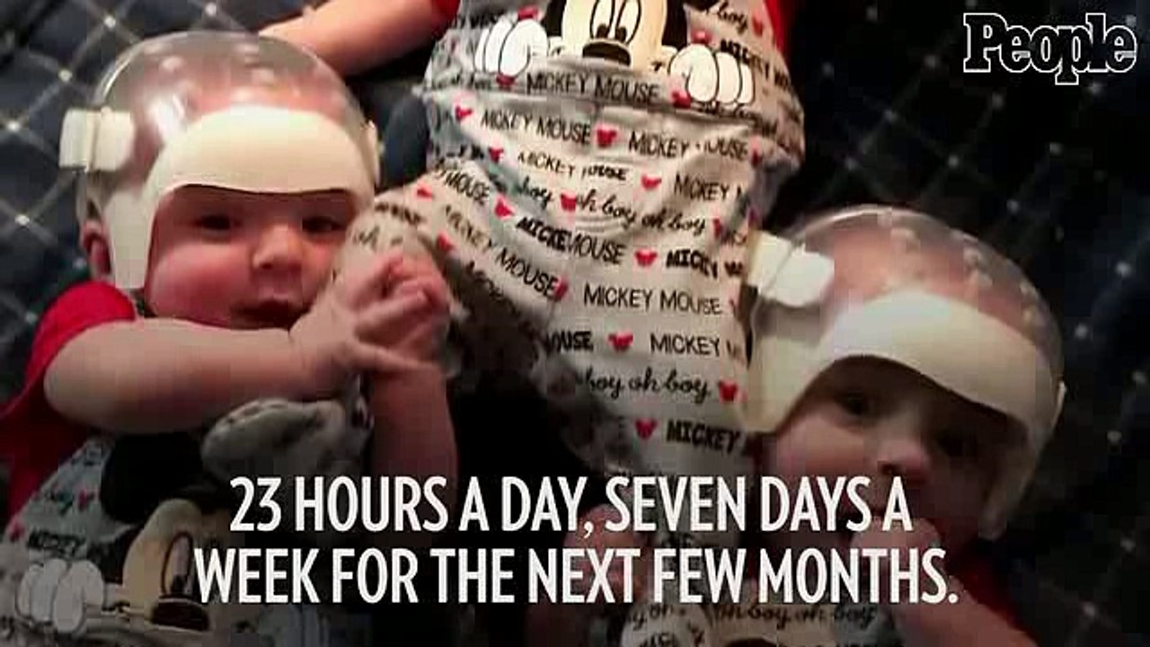Triplets undergo first ever surgery to fix rare skull condition