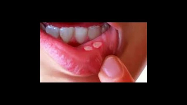 Muh ke chhale theek karne ka upaay | मुह के छाले ठीक करने का उपाय @ Desi upchar