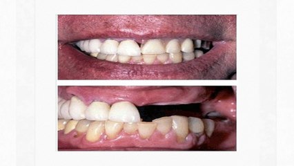 Invisalign Irvine