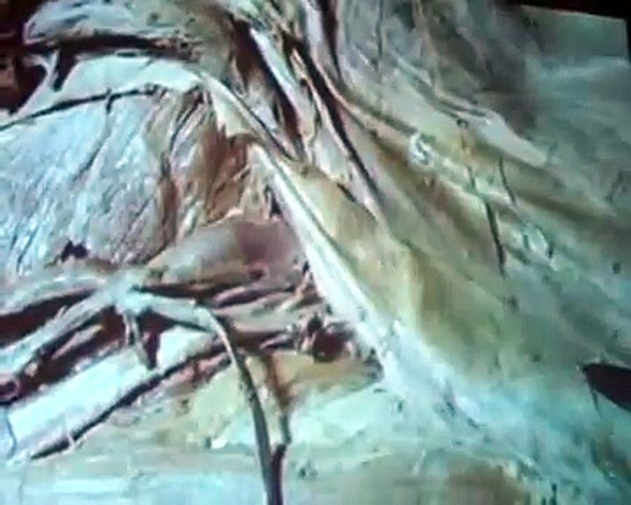 ANATOMIA 2.0_ CANAL INGUINAL DISECCION Parte 1