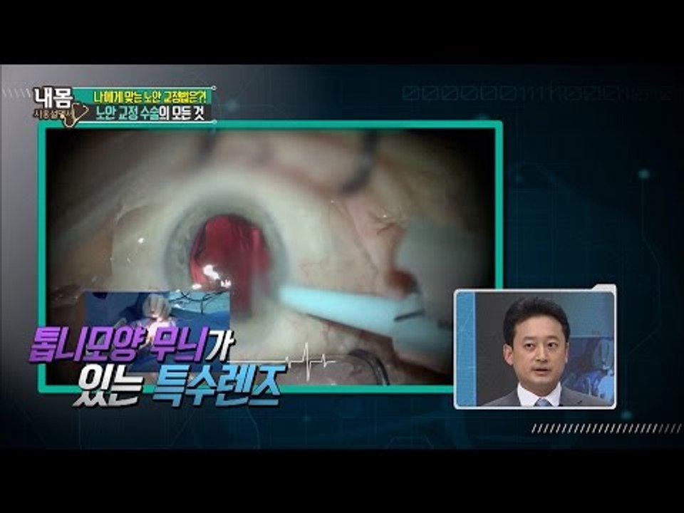 다초점 인공 수정체 삽입술 실제 장면! [내 몸 사용설명서] 108회 20160624