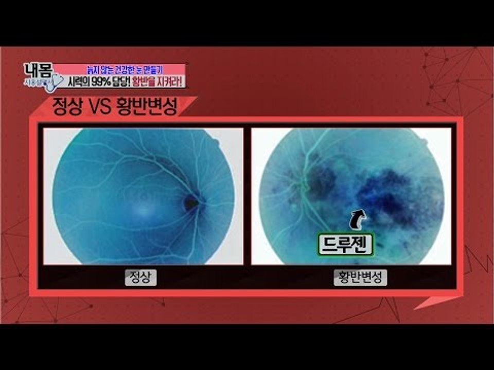 실명질환 1위 황반변성, 당신도 예외는 아니다! [내 몸 사용설명서] 108회 201...