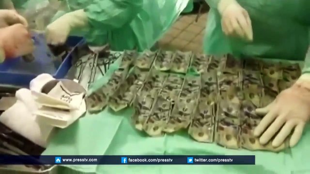 Mauvaise cachette les médecins retrouvent 7000$ dans l'estomac d'une femme