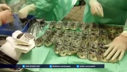 Mauvaise cachette   les médecins retrouvent 7000$ dans l'estomac d'une femme