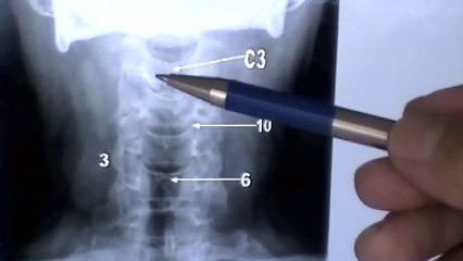 ANATOMIA 2.0_ INTERPRETACION DE ESTUDIOS RADIOLOGICOS DE COLUMNA
