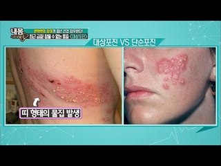 면역력이 떨어지면 대상포진이 생긴다![내 몸 사용설명서] 107회 20160617