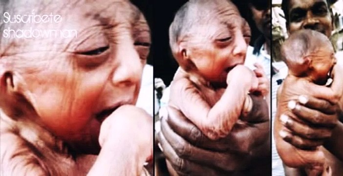 NACE BEBE CON APARIENCIA DE 90 AÑOS - 'INSOLITO' ¿BENJAMIN BUTTON REAL - NACE BEBE 'ANCIANO'