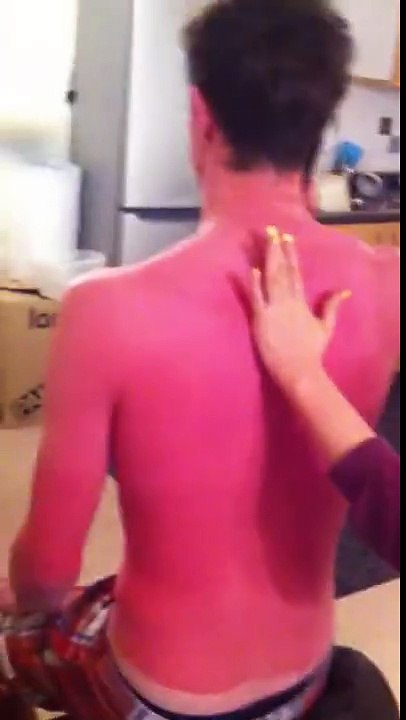 Un anglais a oublié de se mettre de la crème solaire et n'avait pas prévu ça