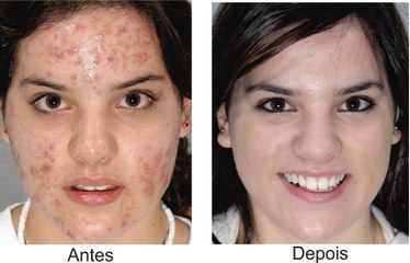 como acabar com as espinhas de uma vez por todas