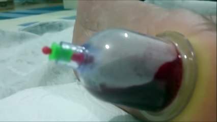 Ayak Topuğuna Hacamat Nasıl Yapılır...