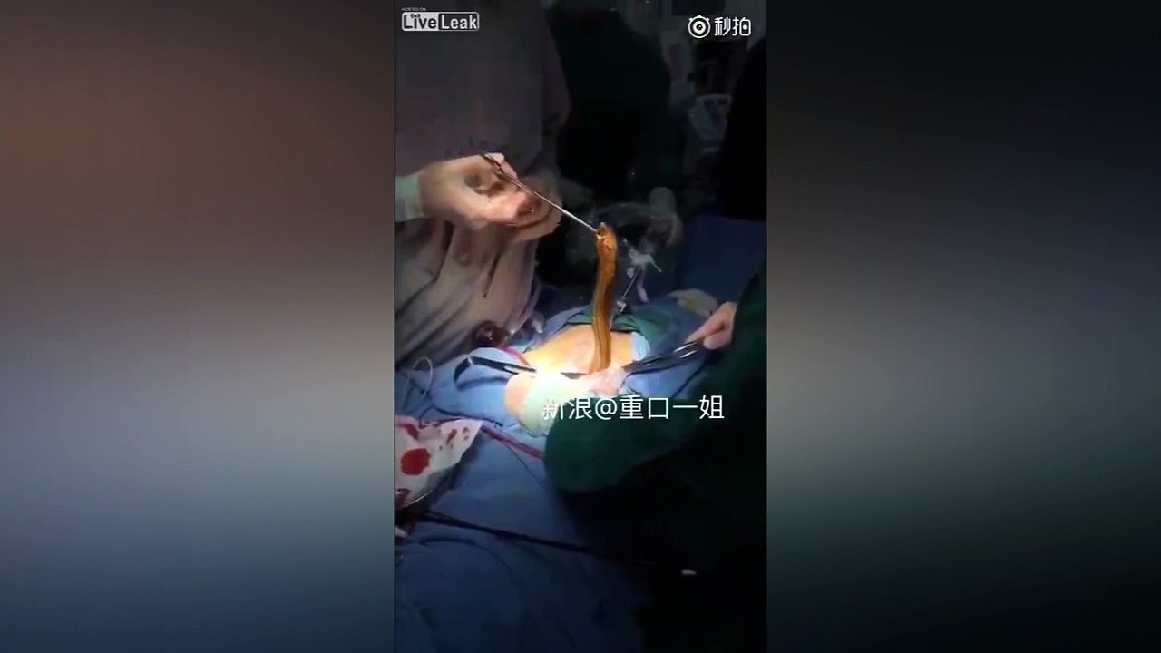 Disgusting footage shows live eel being removed from patients body during operation - Mirror Online