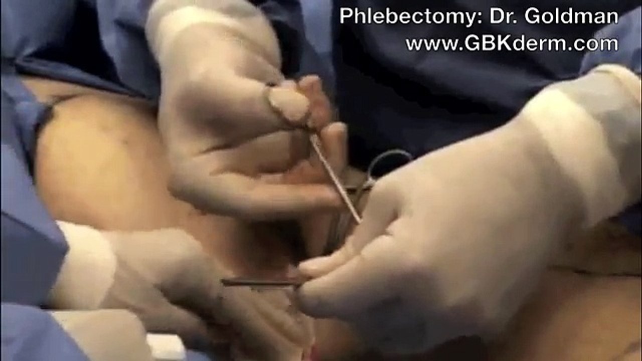 Leg Vein
