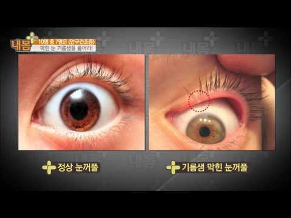 안구건조증! 1분이면 해결! [내 몸 사용설명서 플러스] 3회 20160424