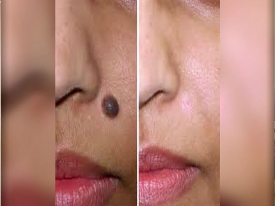 Lunares pueden producir cáncer