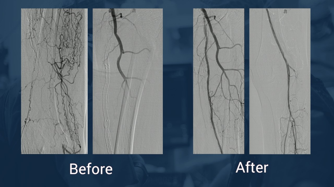 Long instent re-occlusion and P1-P2 occlusion