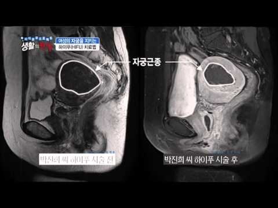여성의 자궁을 지키는 하이푸 치료법 [생활의 한수] 1회 20160303