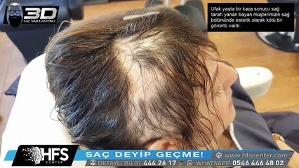 Kadınlarda saç simülasyonu nasıl yapılır ?