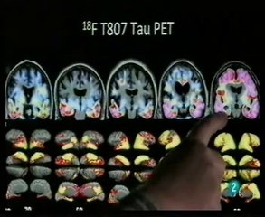 Alzheimer: Hipotesis de la TAU (PET-TAU)