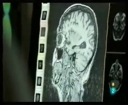 DTA: Demencia tipo Alzheimer