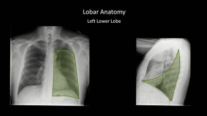 How to Interpret a Chest X-Ray (Lesson 8 - Focal Lung Processes)