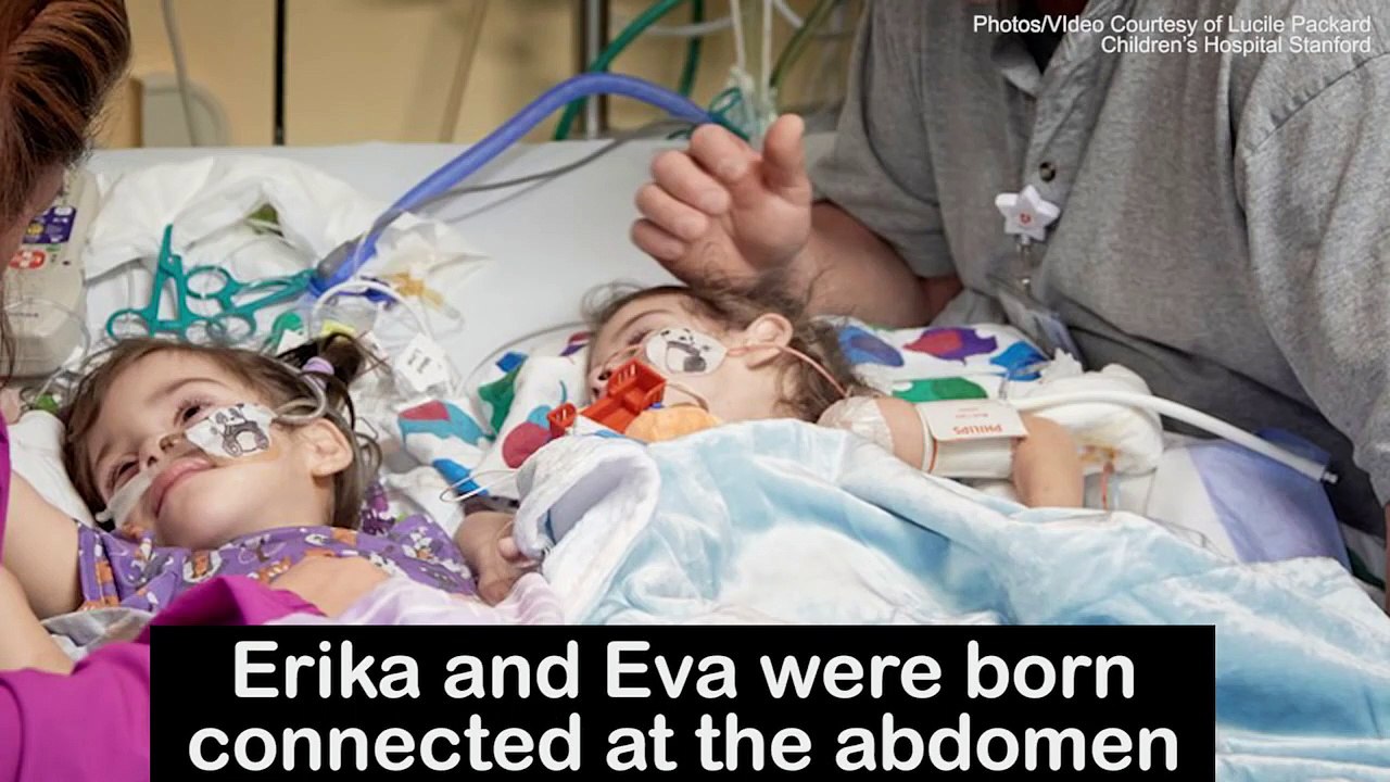 The moment conjoined twins see each other after separation-ooR_LBC4Waw