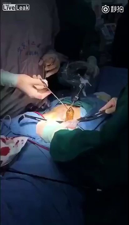 Cet homme se fait enlever une énorme anguille