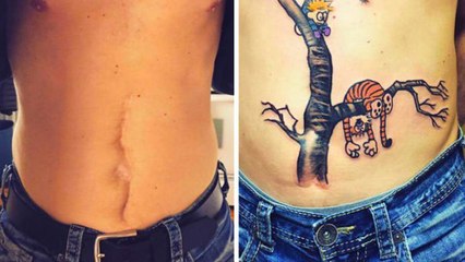 Inspirational Tattoos That Turn Scars Into Beautiful Works Of Art