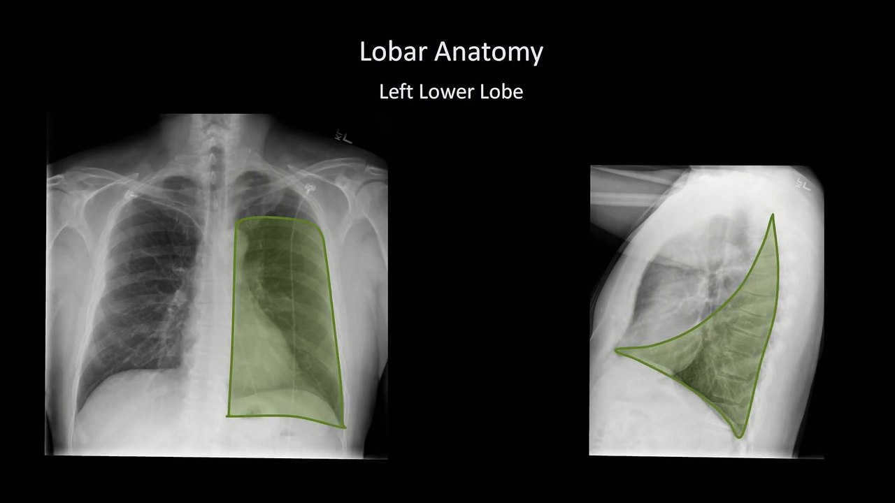 How to Interpret a Chest X-Ray (Lesson 8 - Focal Lung Processes)