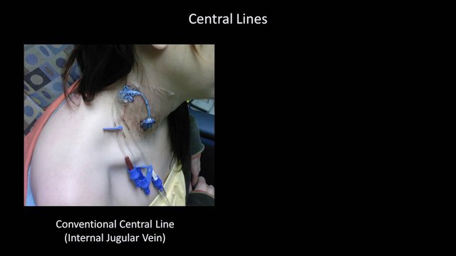 How to Interpret a Chest X-Ray (Lesson 9 - Atelectasis, Lines, Tubes, Devices, and Surgeries)
