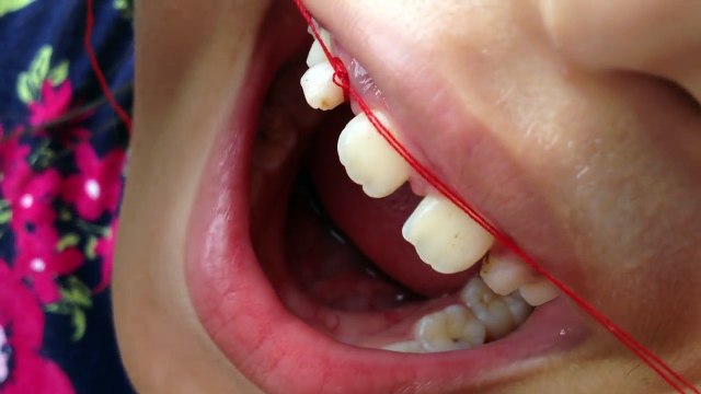 How to extract the teeth of fathers' babies in Vietnam
