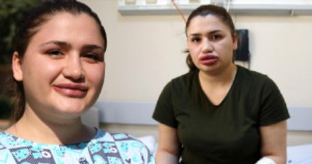 Dudaklarını Kaybetmekten Kıl Payı Kurtulan Merve Hemşire İyileşmeye Başladı