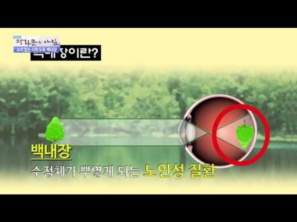 소리 없는 시력도둑 백내장 [광화문의 아침] 103회 20151103