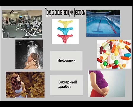 Методы лечения молочницы. Как вылечить молочницу народными средствами