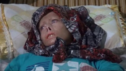 Esad'ın Yaktığı Suriyeli Nuha Türkiye'de Şifa Buluyor