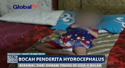Akibat Demam Tinggi di Usai 4 Bulan, Bocah di Tuban, Menderita Hydrocephalus Selama 9 Tahun