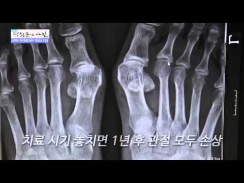 전신 합병증 부르는 류마티스 관절염 [광화문의 아침] 88회 20151013