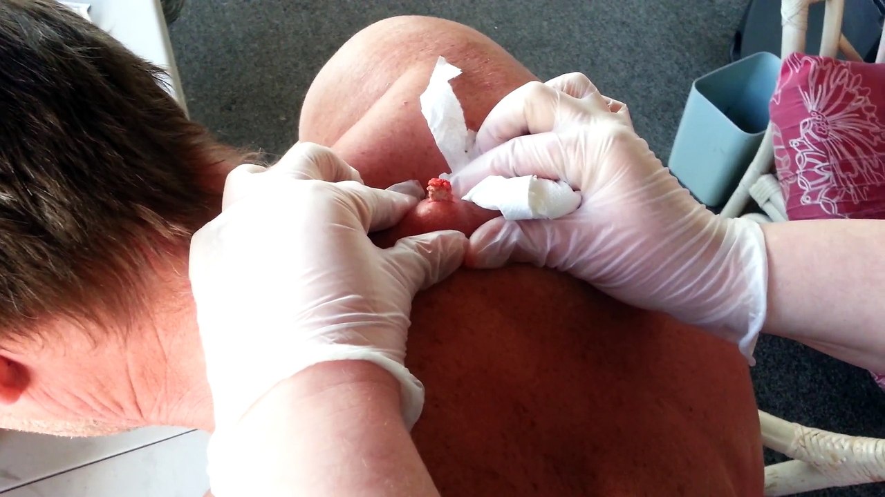30 Year Old Cyst Explosion