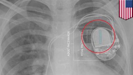 Medical breakthrough: Fetal pacemaker ready for human trials