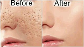 How to make over & Get Rid of Large Pores