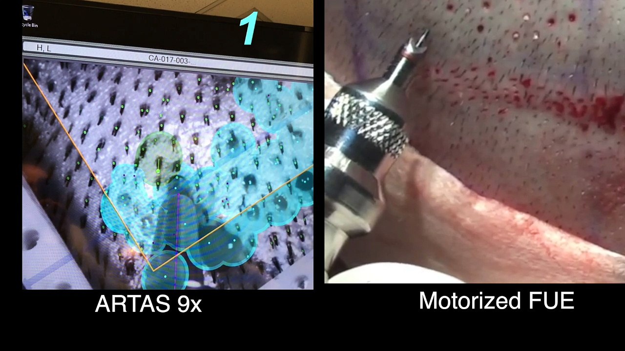 9x harvesting comparaison ARTAS / MAIN