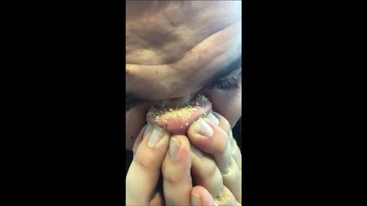 Il fait sortir des dizaines de points noirs de son nez en pressant dessus