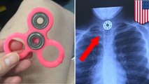 Fidget spinner dangers: Texas girl chokes on fidget spinner she accidentally swallowed