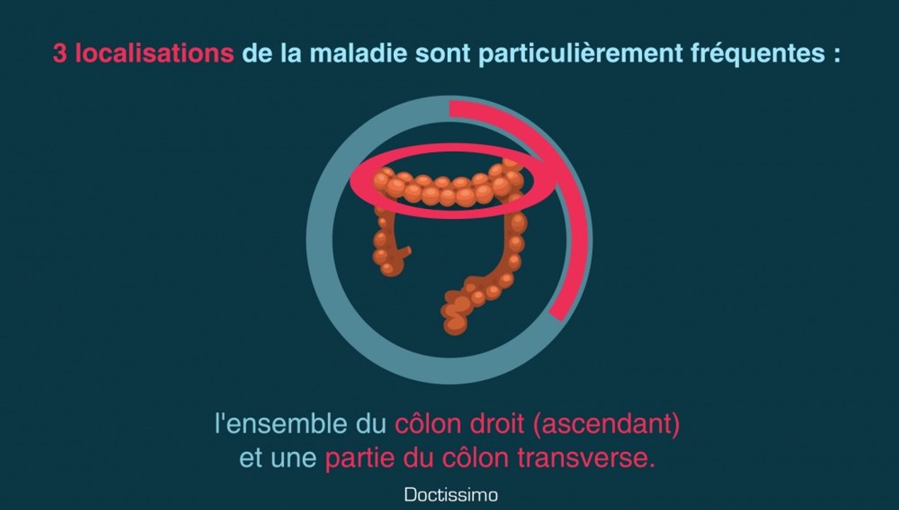 Maladie de Crohn : symptômes et traitements