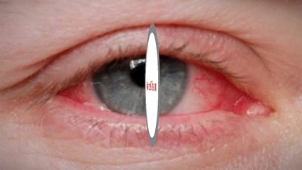 Lasik Manhattann - Mandel Vision (888) 866-3681